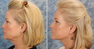 Face Lift, Brow Lift & Lower Bleph   